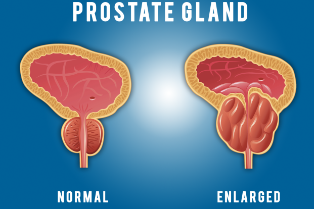 Prostate